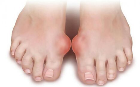 Hallux Valgus Fortolex