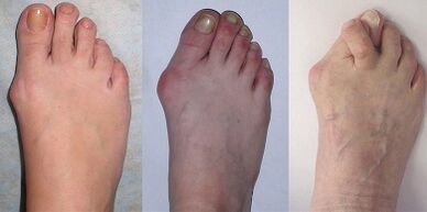 hallux valgus stages