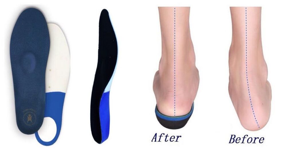 Orthopedic insoles for planovalgus foot deformity