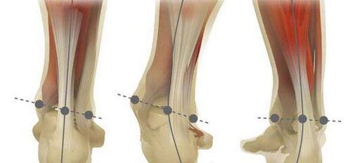 The norm of the axis of the foot and its curvature in case of planovalgus deformity