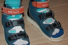 using sandals for hallux valgus in a child