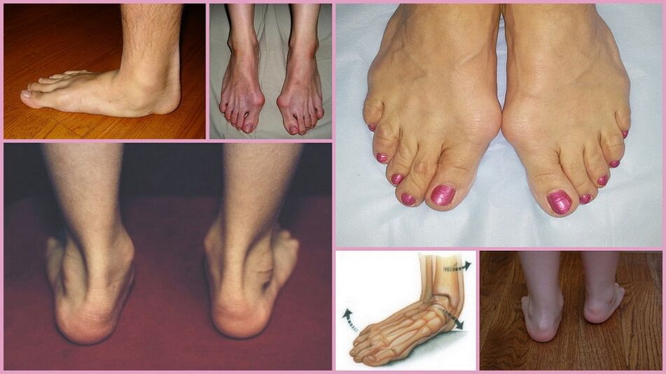 Valgus foot manifestations in adults
