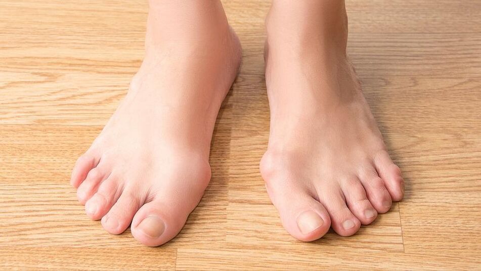 hallux valgus