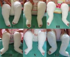 Casting procedures, each of which changes the position of the foot