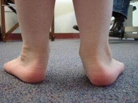 Valgus flatfoot deformity in a child