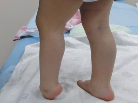 The first symptoms of Valgo deformation of the foot