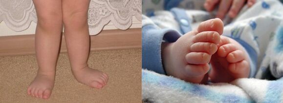 VALGO FOOT DEFORMATION