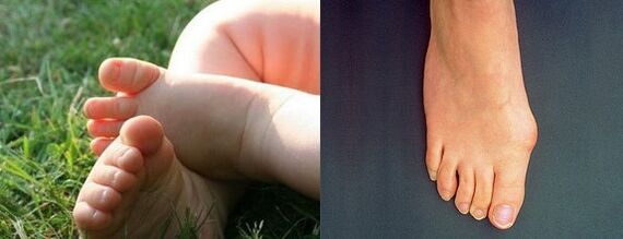 Valgo deformation of the first toe
