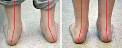 Valgus curvature