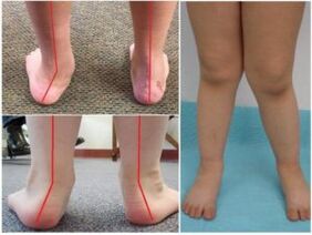 Valgus